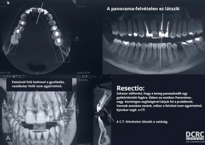 Resectio - CT-felvétel
